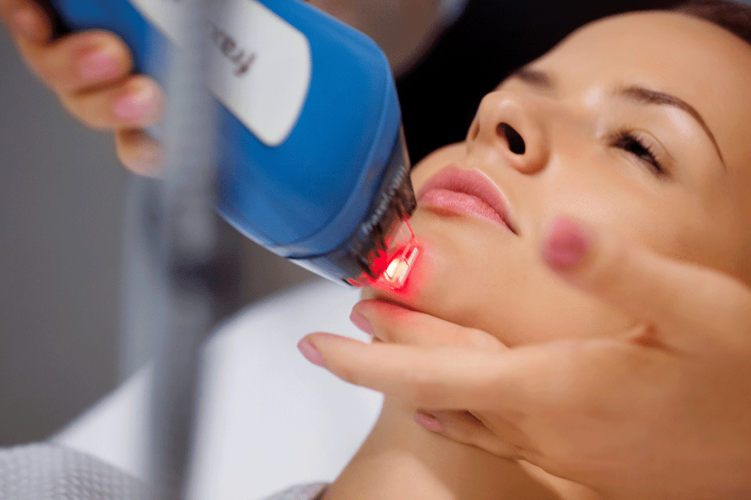 Peremajaan laser pada kulit wajah