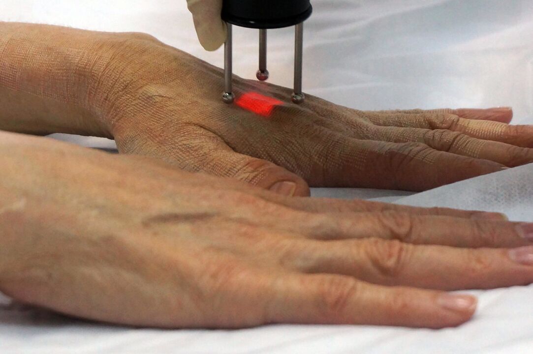Peremajaan laser tangan menggunakan kaedah bukan ablatif