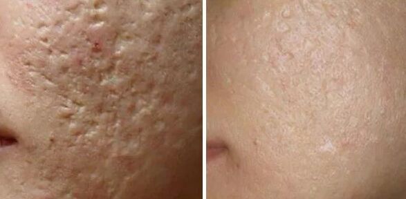 Gelung laser parut