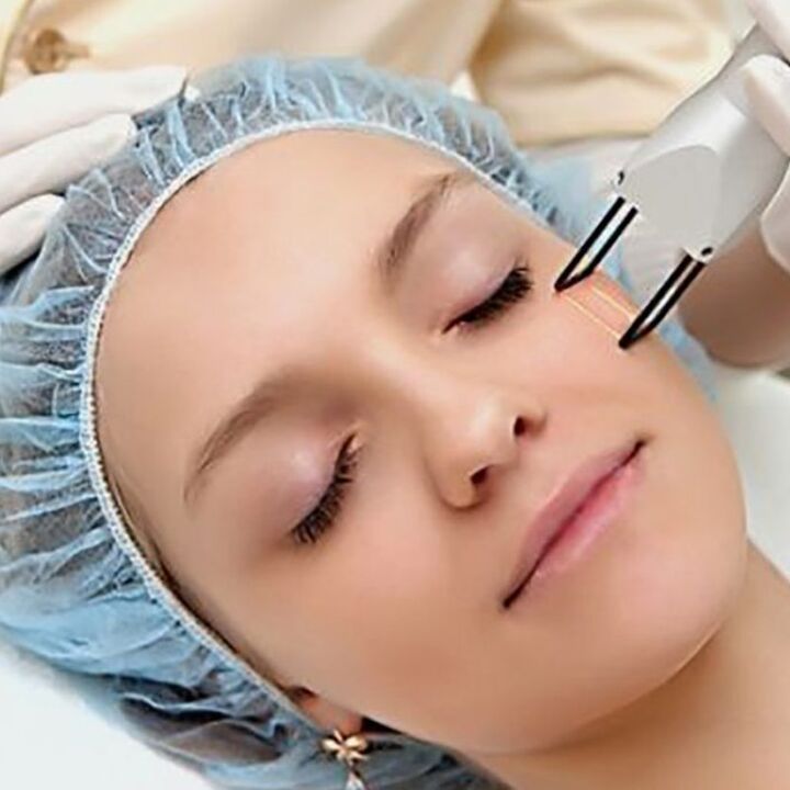 Peremajaan pecahan laser
