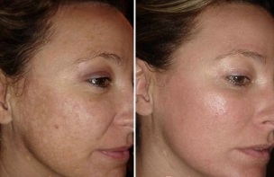 Peremajaan wajah laser sebelum dan selepas foto